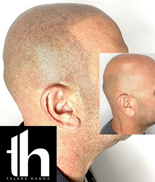 micro scalp pigmentation sydney